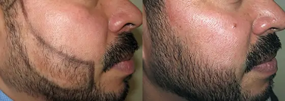 Beard Transplant
