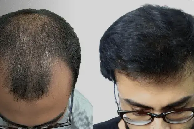 Hair Transplant in Androgenetic Alopecia
