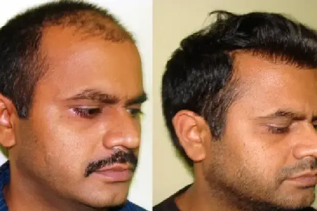 Causes of Male Pattern Baldness