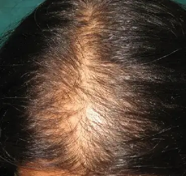 Hair Loss in Women