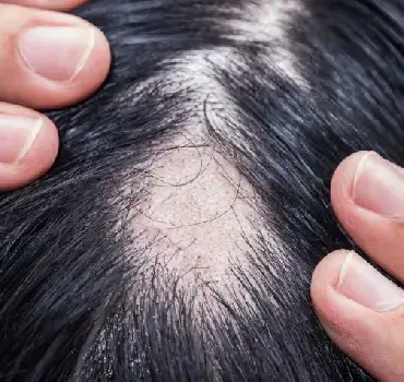 Female Pattern Baldness